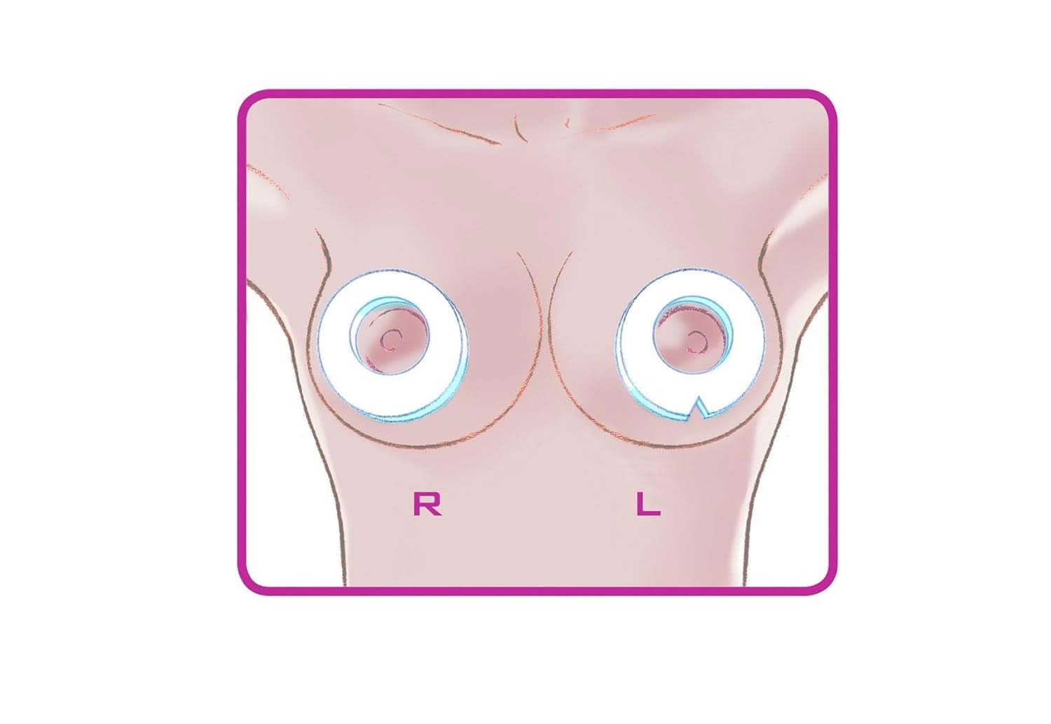 ELANEE Brust-Ringe, Schutz Der Brustwarze Bh-Kontakt Durch Hohllagerung, Ideal Bei Wunden, Entzündeten Brustwarzen Durch Stillen, 10 Stück (222-00) Accesorii Hrana si Alaptare Bebe Naty Shop