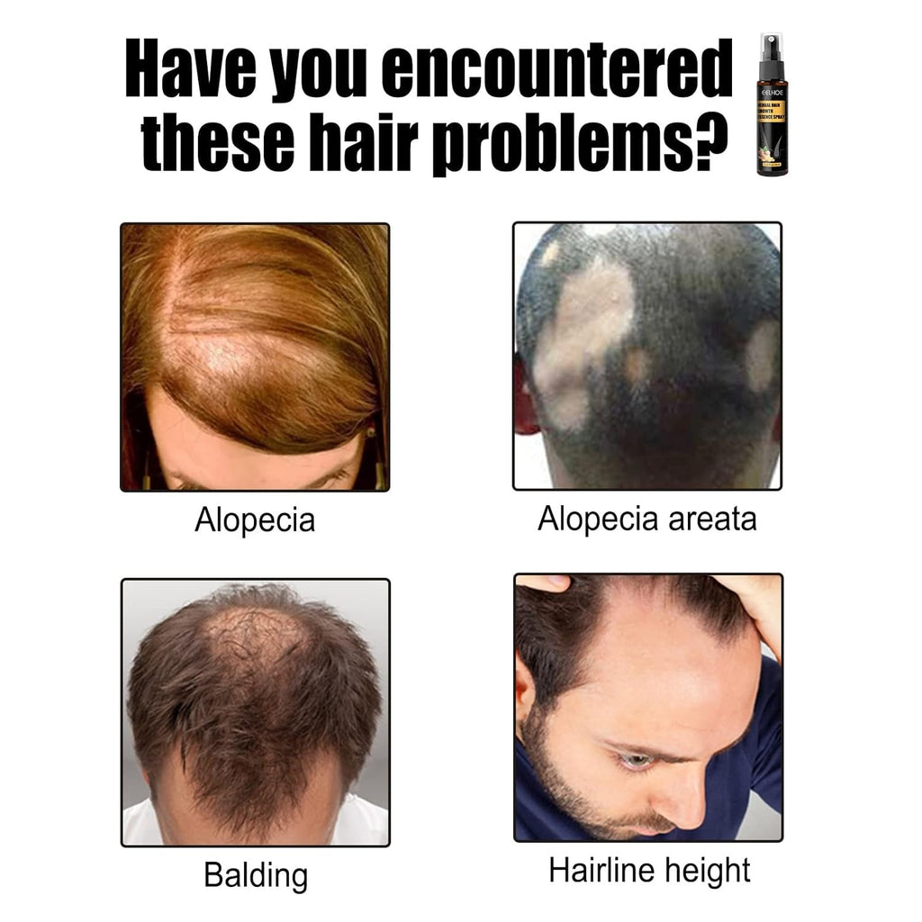 Kit de tratament avansat pentru creșterea părului 30ml 2PCS, spray pentru creșterea părului, set de role și esențe pentru creșterea părului, ser pentru creșterea părului, împotriva căderii părului, ser pentru creșterea avansată a părului Ingrijirea parului Naty Shop