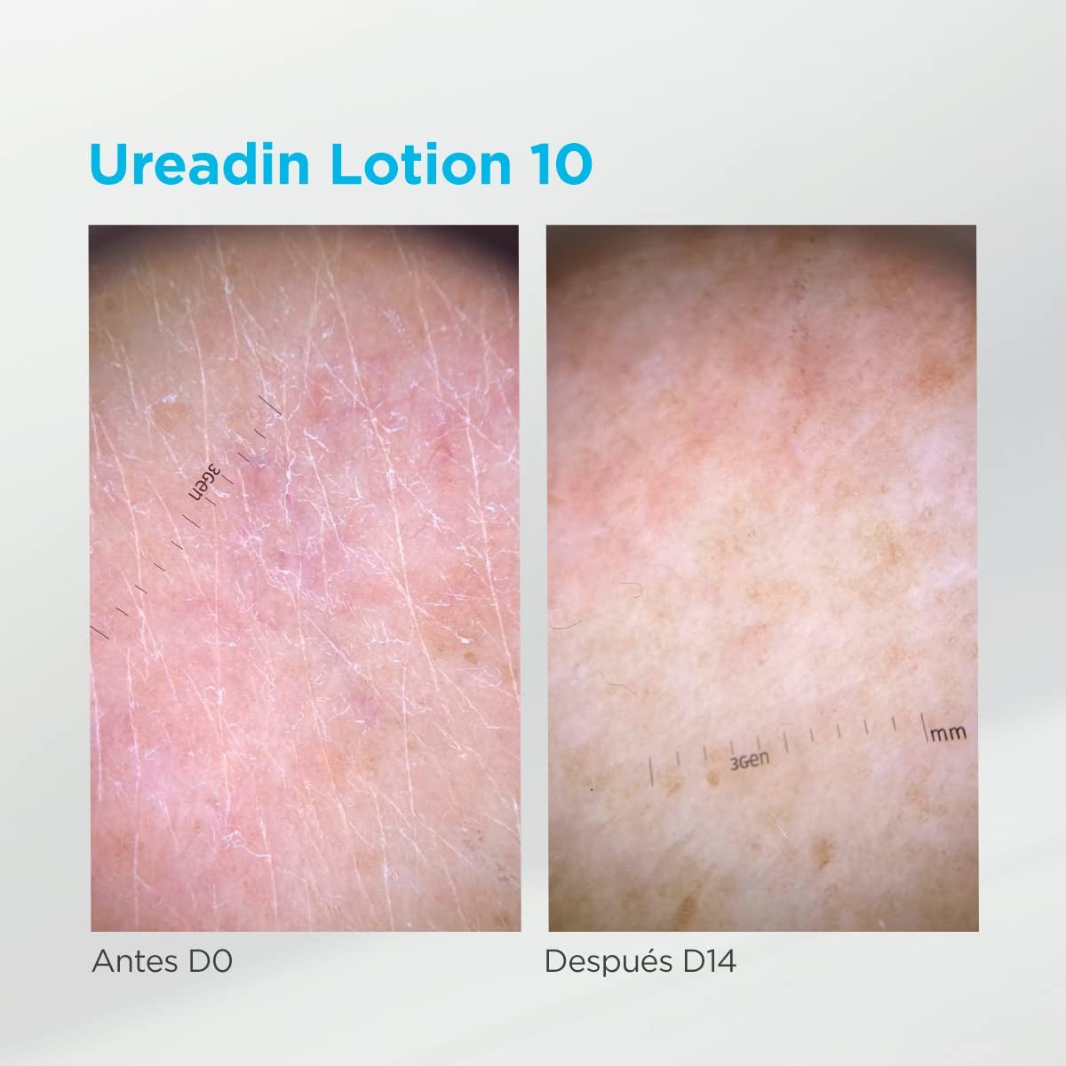 ISDIN Ureadin Lotion 10 (1000ml) | Loțiune de corp cu hidratare intensivă pentru pielea uscată 10% uree Copii - Baie si Skincare Naty Shop